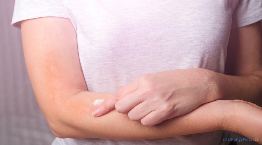 Frau cremt ihre Neurodermitis am Arm ein