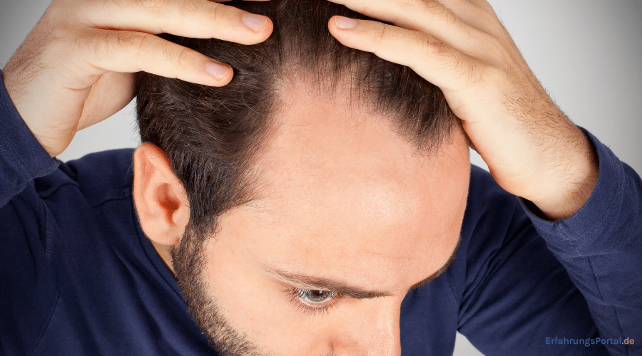 Haarausfall Männer